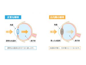 白内障