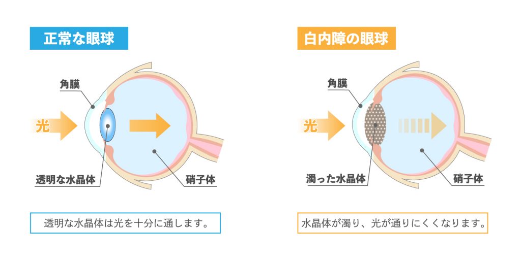 白内障